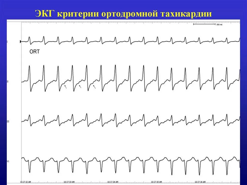 Пароксизмальная наджелудочковая тахикардия экг. Пароксизмальная желудочковая тахикардия на экг. Предсердная пароксизмальная тахикардия на экг. Критерии тахикардии. Синусовая тахикардия диагностические критерии.