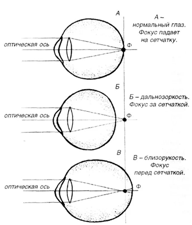 Фокусировка глаза человека. Схема строения глазного яблока при близорукости. Схема строения глазного яблока при близорукости и дальнозоркости. Дальнозоркость и близорукость строение глаза. Строение глаза при близорукости и дальнозоркости.