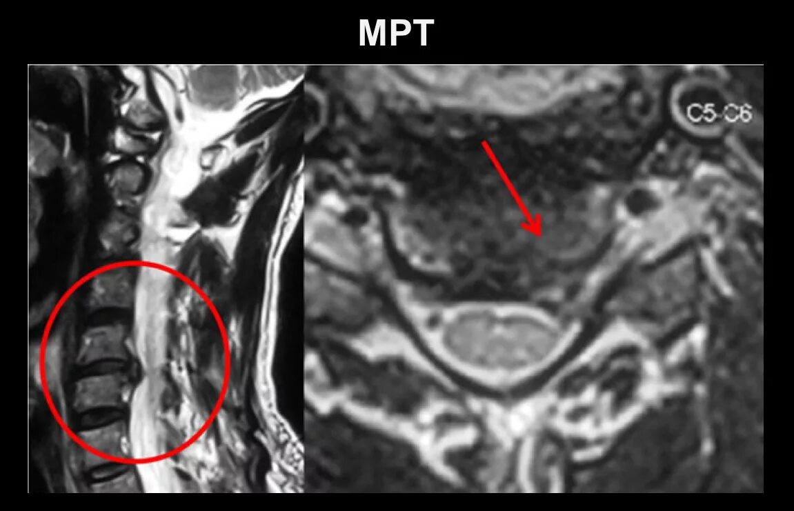 Грыжа 6 мм. С5-с6 на мрт. Грыжа шейного отдела с5-с6 операция позвоночника. Грыжа шеи с5 с6. Грыжа c5-c6 мрт.