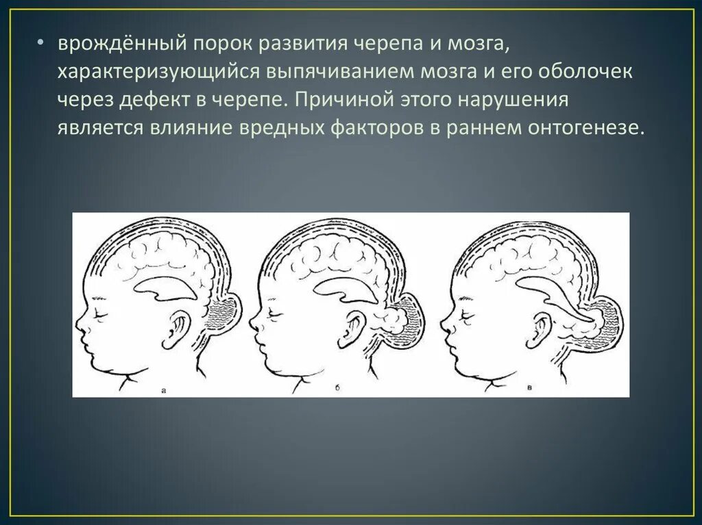 Черепная аномалия. Пороки развития черепа и головного мозга. Варианты и аномалии развития черепа.. Врожденные пороки развития черепа.