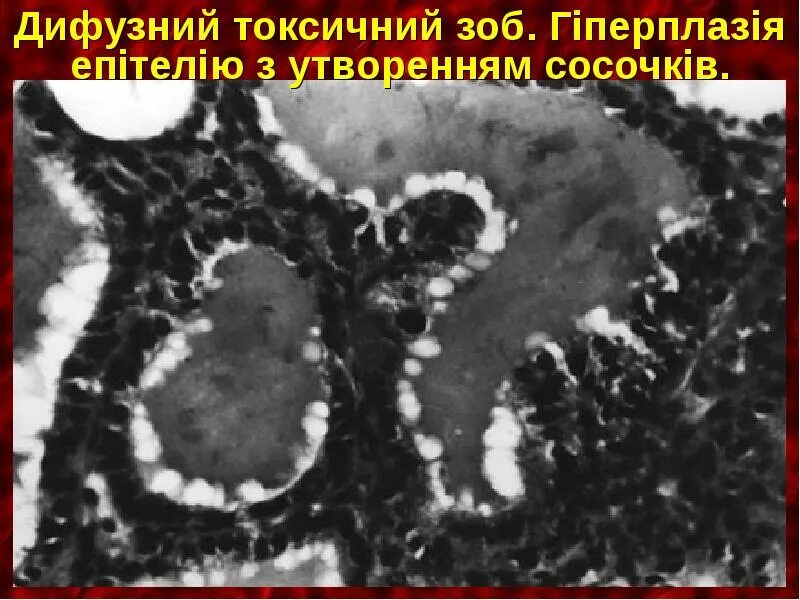 Диффузный токсический зоб щитовидной железы. Классификация зоба щитовидной. Эндемический и токсический зоб. Эндемический зоб щитовидной железы. Эндемический и токсический зоб.