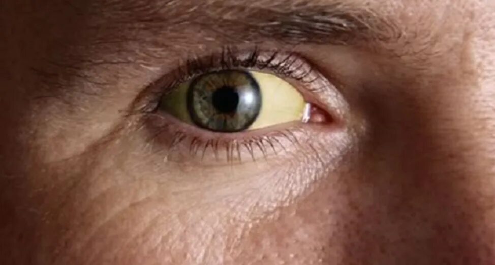 Пожелтение склер гепатит. Желтые глаза. Почему глаза желтые причина