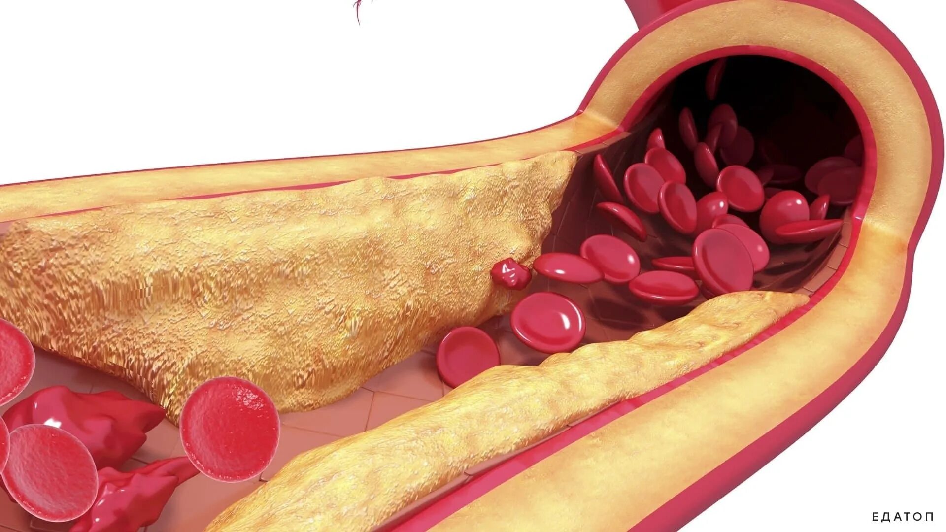 Чем чистить холестериновые бляшки. Холестериновые бляшки в сосудах. Жировые бляшки в сосудах. Атеросклеротическая бляшка.