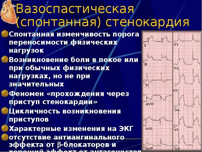 St ишемия. ИБС стенокардия ЭКГ признаки. Ишемия стенокардия на ЭКГ. ЭКГ критерии стабильной стенокардии. Вне приступа стенокардии у больных на ЭКГ:.