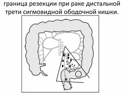Стадии рака сигмовидной кишки