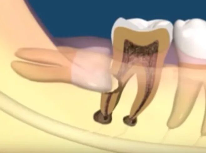 Dos and Don'ts to help you recover after wisdom tooth extraction.