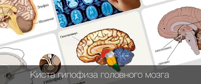 киста гипофиза головного мозга симптомы. киста гипофиза головного мозга лечение. киста гипофиза головного мозга лечение. гипофиз головного мозга симптомы. операция аденомы гипофиза через нос.