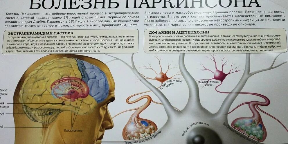 Болезнь Паркинсона черная субстанция. Мозг при болезни Паркинсона.