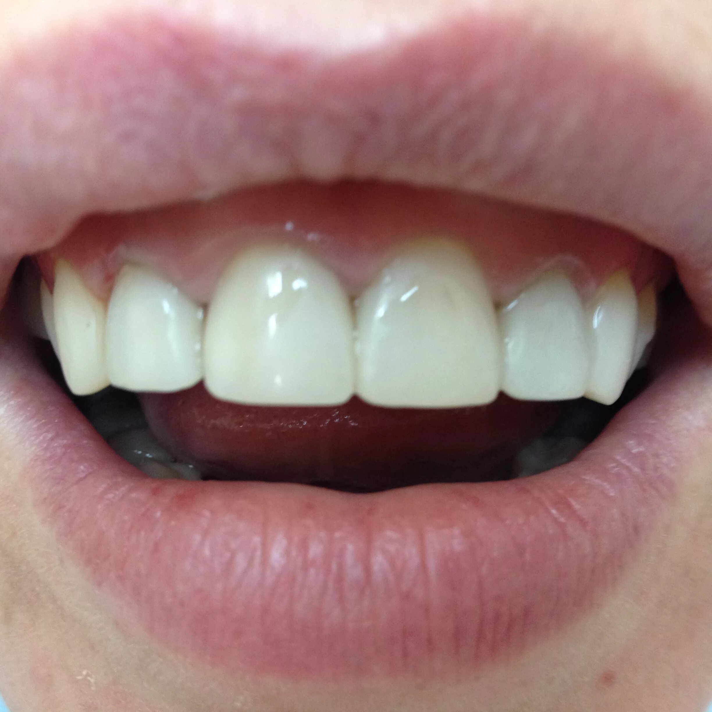 нарастить зуб протез