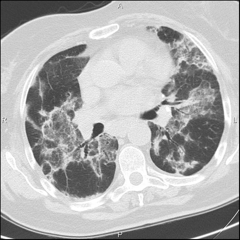 Кт легких 80 процентов поражения. Поражение лёгких 80 процентов. Легкие пораженные на 80 процентов. 80 поражения легких