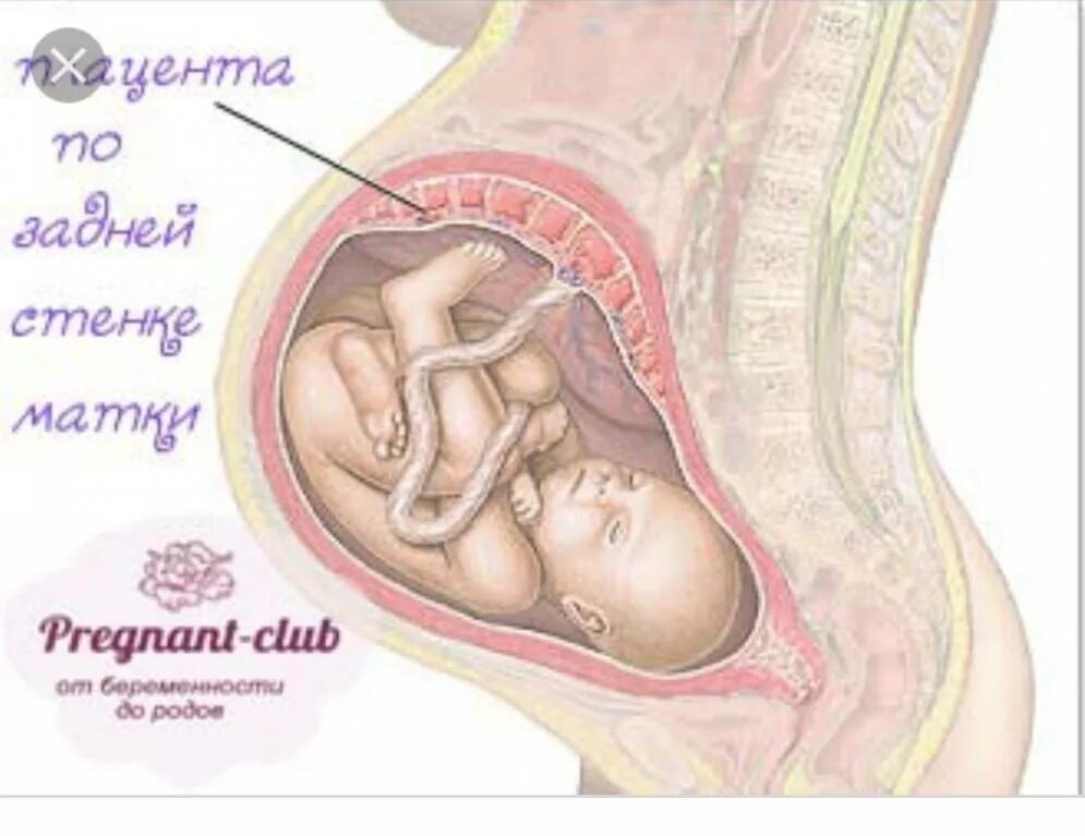 Где находится роды. Хорион плацента пуповина. Хорион плацента матка. Плод пуповина плацента при беременности. Плацента по передней и задней стенке.