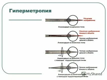 Гиперметропия слабой степени мкб