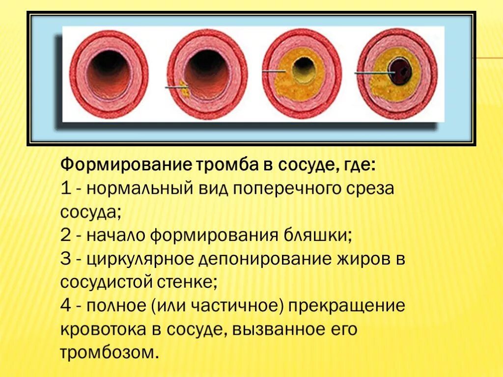 Атеросклероз презентация. Презентация на тему атеросклероз. Атеросклероз бляшки сосудов. Эффективные лечения атеросклероза