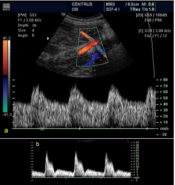 Доплер артерий. Импульсная спектральная допплерография. УЗИ допплер аппарат. Доплеровский эффект УЗИ. УЗИ импульсный допплеровский режим.