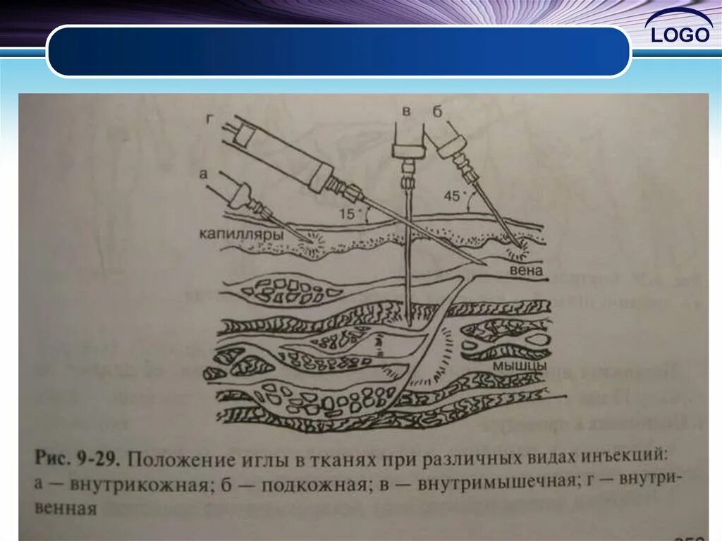 Внутривенно под каким углом. Внутривенная инъекция угол введения иглы. Внутривенная инъекция глубина введения иглы. Внутривенное Введение угол введения иглы. При постановке внутривенной инъекции игла вводится под углом.