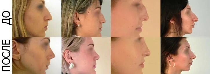 Ринопластика. Ринопластика до и после. Исправление горбинки носа. Ринопластика искривление носовой.