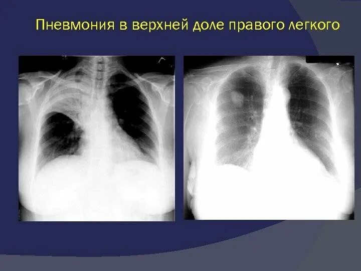 Рентген пневмония средней доли. Правосторонняя очаговая пневмония рентген. Правосторонняя нижнедолевая пневмония рентген. Крупозная пневмония рентгенограмма. Тотальная левосторонняя пневмония рентген.