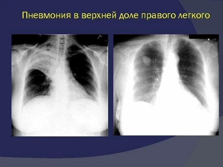 Правосторонняя очаговая пневмония рентген. Крупозная долевая пневмония. Правосторонняя верхнедолевая крупозная пневмония.. Пневмония верхней доли левого легкого рентген. Пневмония в нижней доле правого легкого