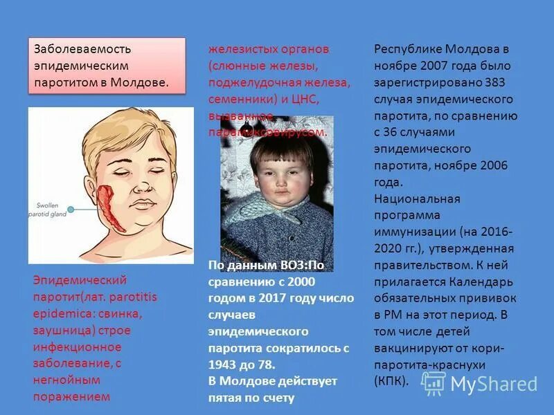 Паротит возможные осложнения. Паротит частота заболевания. эпидемический паротит слюнные железы. эпидемический паротит заболеваемость.