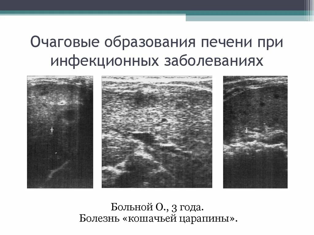 Округлые образования печени. Очаговые поражения паренхимы печени.. Очаговое поражение печени на УЗИ. Очаговые образования в печени на УЗИ.