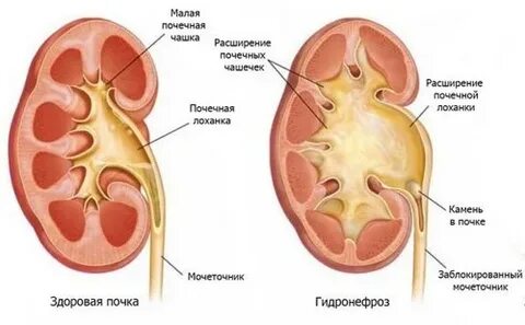 Как лечить гидронефроз почки