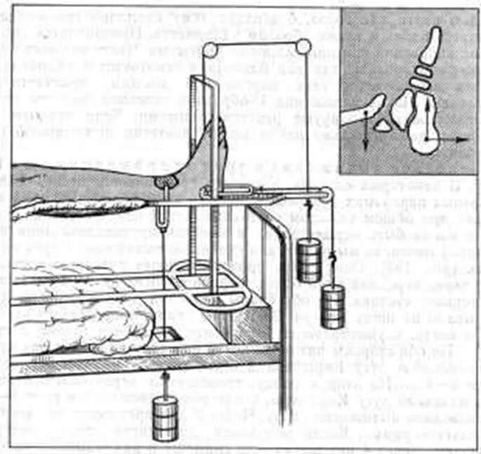 Перелом со смещением сколько на вытяжке. Скелетное вытяжение бедренной кости. Перелом большеберцовой кости скелетное вытяжение. Вытяжка при переломе лодыжки. Вытяжение кости при переломе.