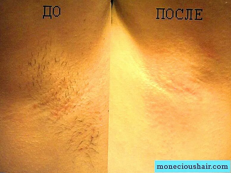 Какой длины должны быть волосы для шугаринга. Волосы до шугаринга и после. волосы до и после депиляции воском. волосы после восковой эпиляции.