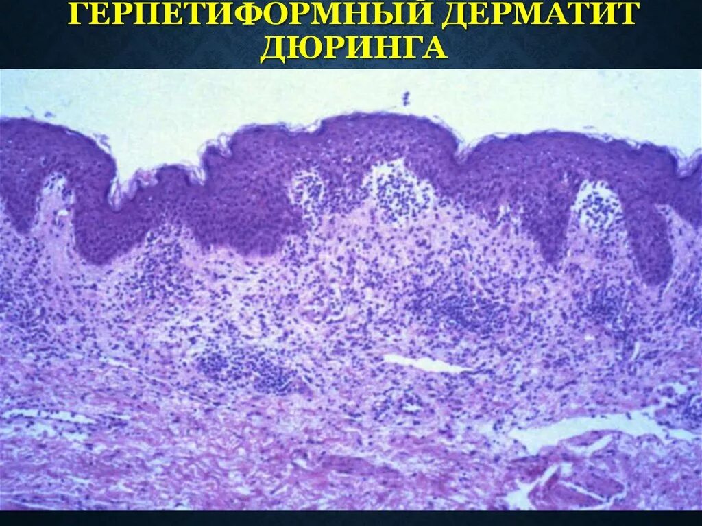 Дифференциальная диагностика розового лишая Жибера - Ответы к тестам НМО на РосМ