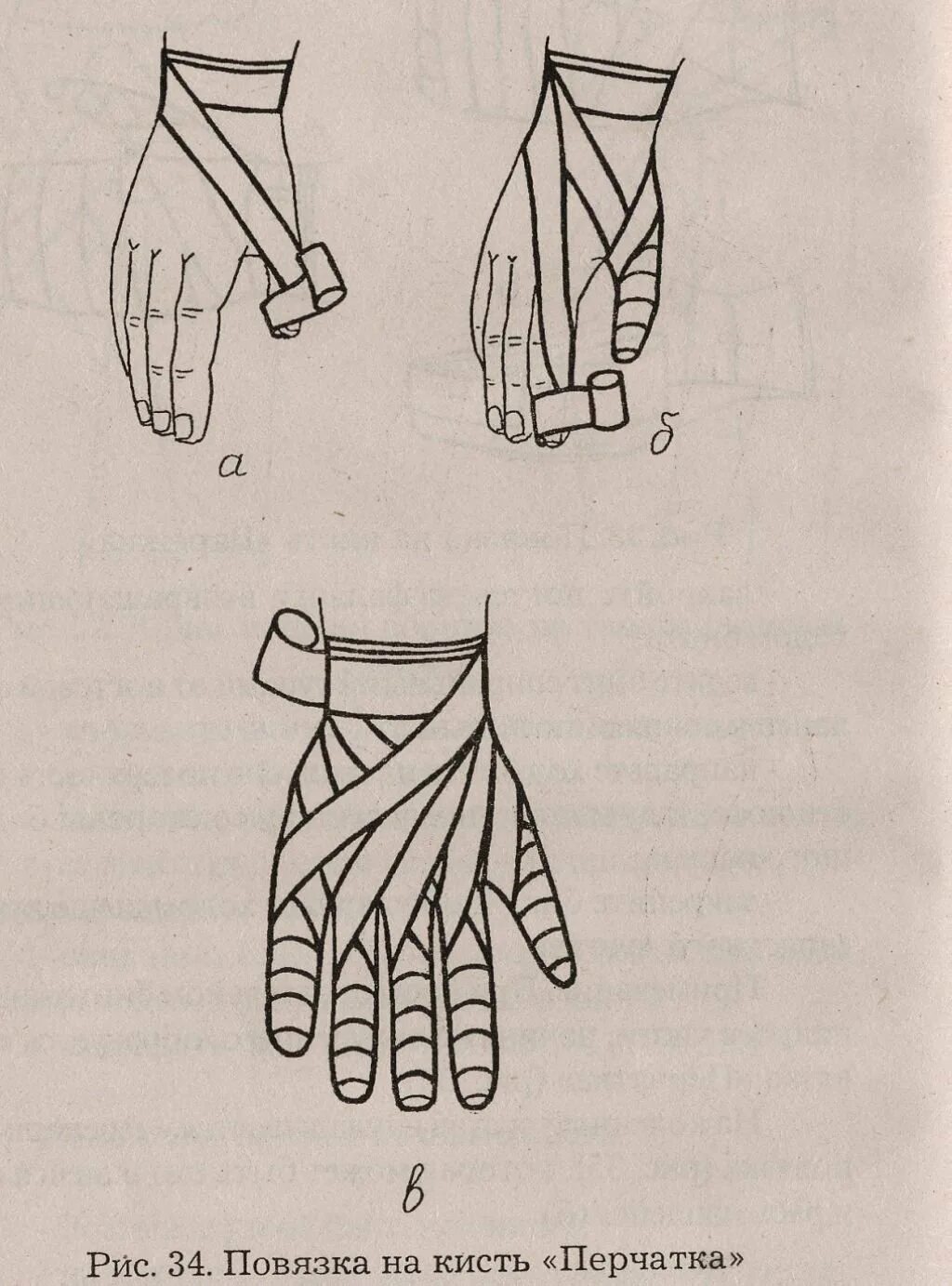 Повязка на руку схема. Бинтование Рыцарская перчатка. Наложение повязки Рыцарская перчатка. Повязка Рыцарская перчатка техника. Рыцарская перчатка перевязка.