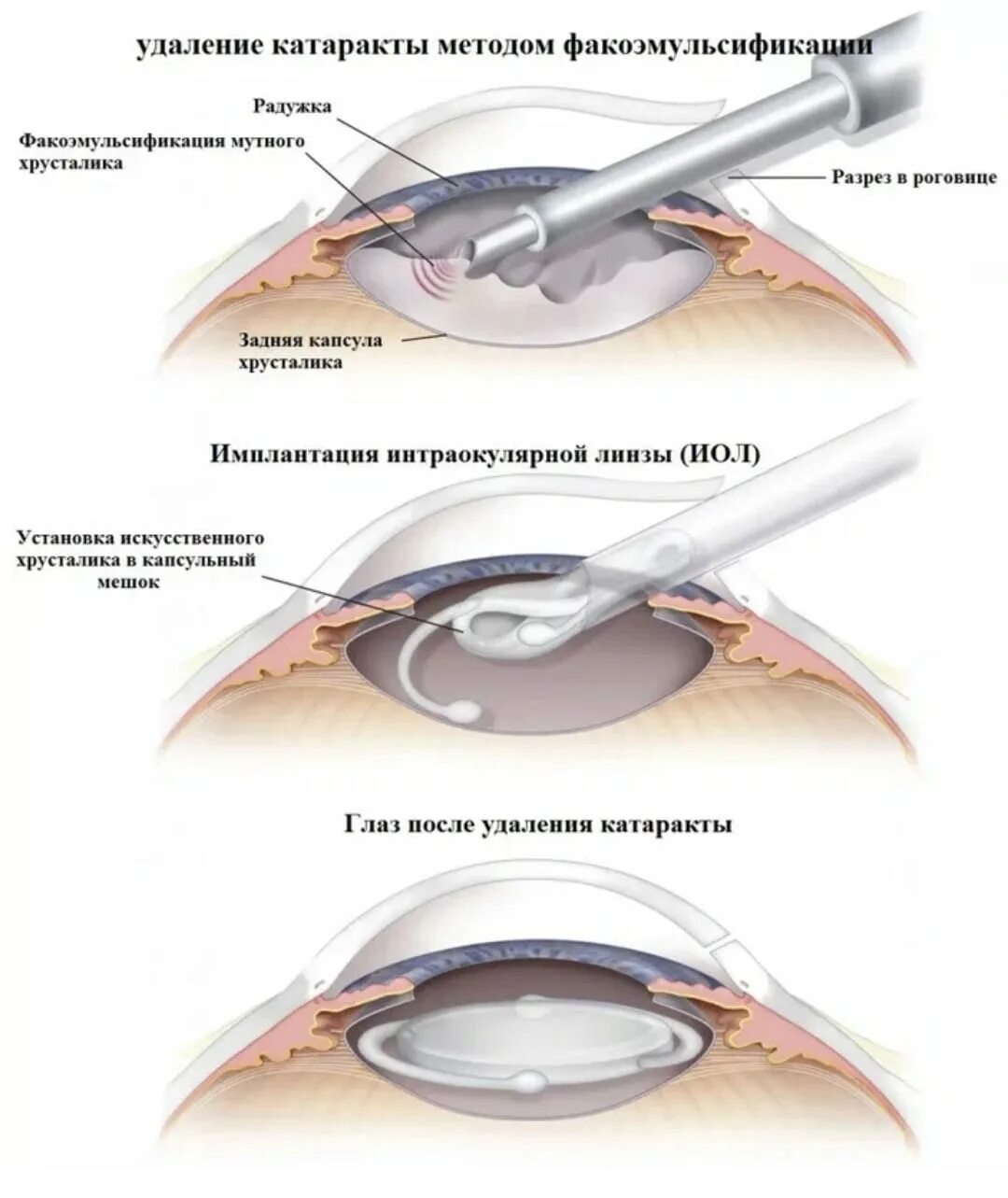 Ультразвуковая факоэмульсификация катаракты этапы. Ультразвуковая факоэмульсификация с имплантацией ИОЛ. Техника факоэмульсификации катаракты с имплантацией ИОЛ. Факоэмульсификация катаракты этапы операции.