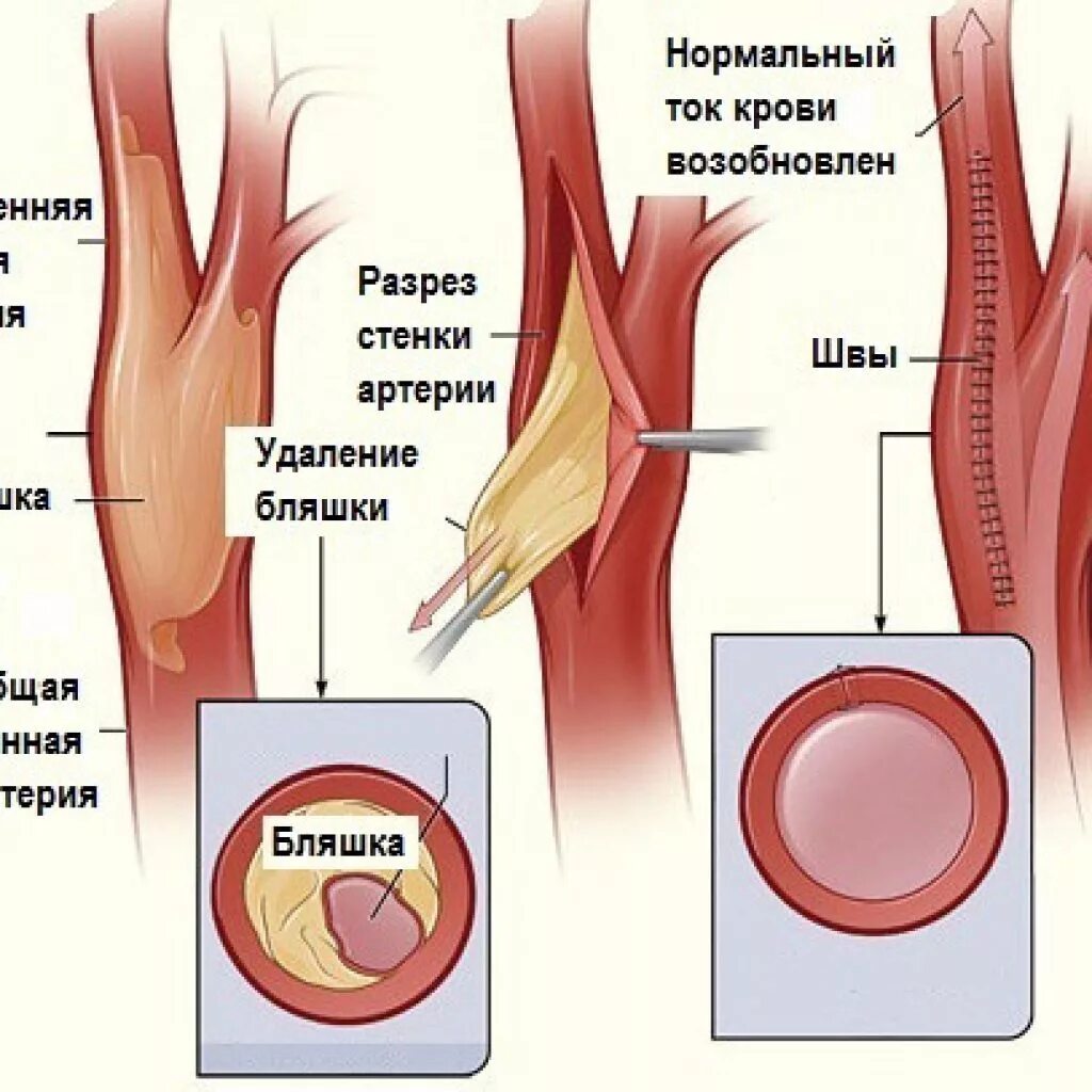 Эндартерэктомия это. Каротидная эндартерэктомия сонной артерии. Холестериновые бляшки в сонной артерии операция. Атеросклеротическая бляшка в сонной артерии. Атеросклероз бляшка сонной артерии операция.