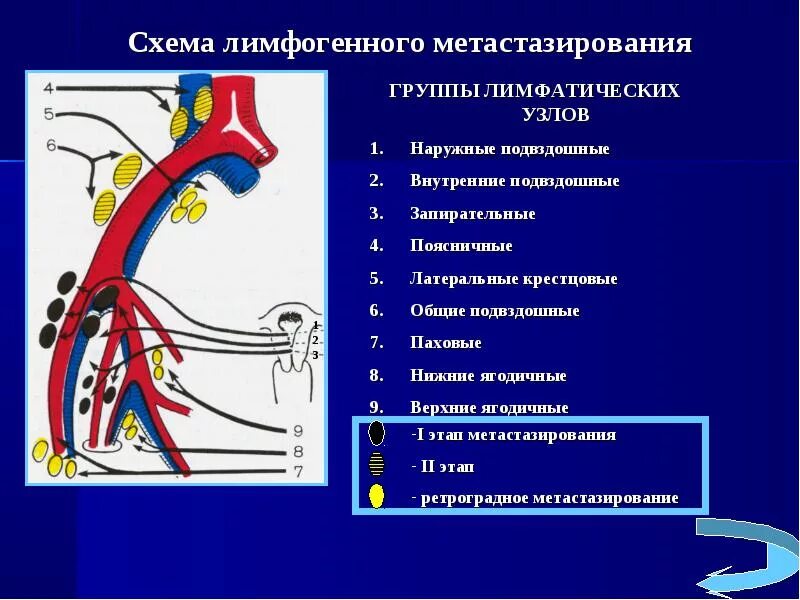 Лимфатические узлы таза схема. Лимфатические узлы малого таза. Тазовые лимфатические узлы. Тазовая лимфаденэктомия. Лимфоузлы и удаление матки