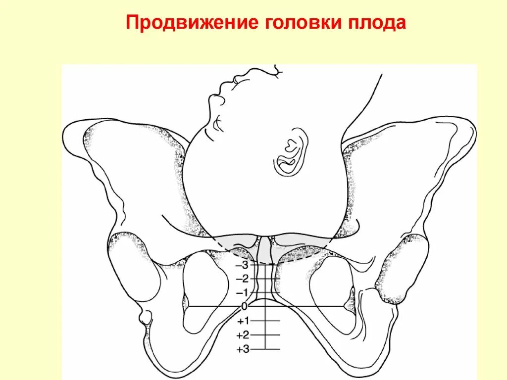 Опускание головки в малый таз. Вставление головки плода в малый таз. Опущение головки плода в малый таз. Вставление головки в таз. Бишопу акушерство