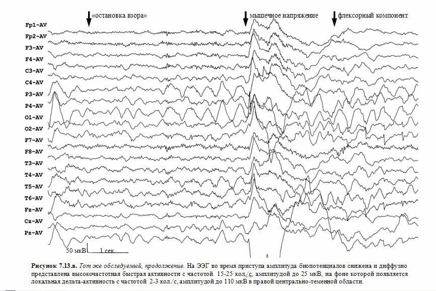 Эпи ээг. Эпилепсия на ЭЭГ. Приступ на ЭЭГ. Эпилептические паттерны на ЭЭГ. Абсансная активность на ЭЭГ.