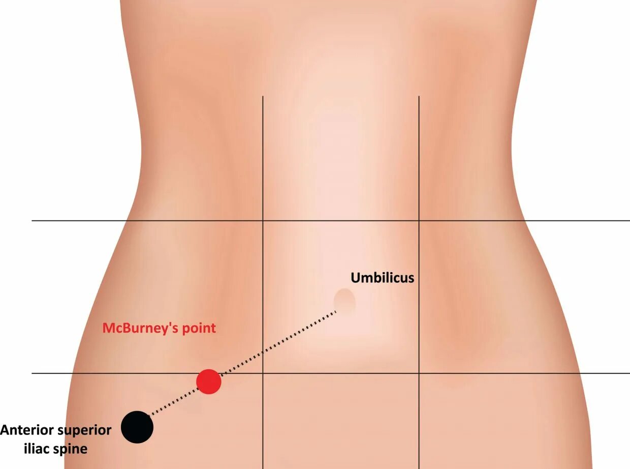 Точка Мак Бурнея при аппендиците. Расположение аппендицита у человека.
