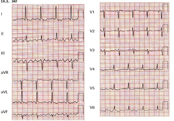 ЭКГ. Экк. Фрагмент нормальной ЭКГ. Графики ЭКГ. Экг сочи