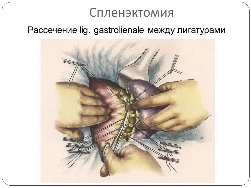 Спленэктомия что это