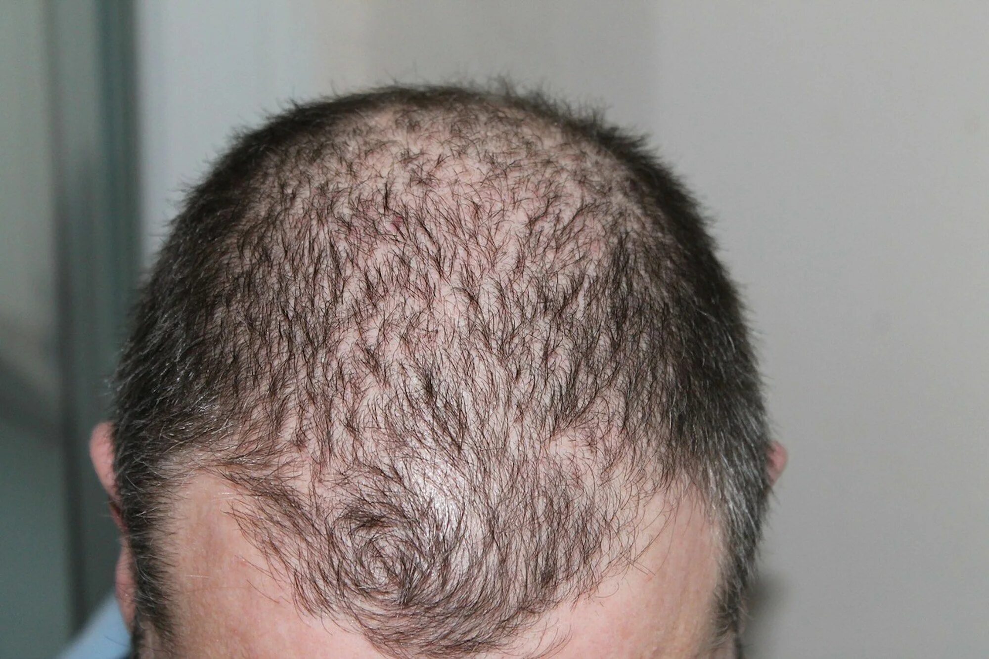 Гнёздная (очаговая алопеция). Очаговая алопеция (alopecia Areata). Андрогенная алопеция алопеция. Неравномерная диффузная