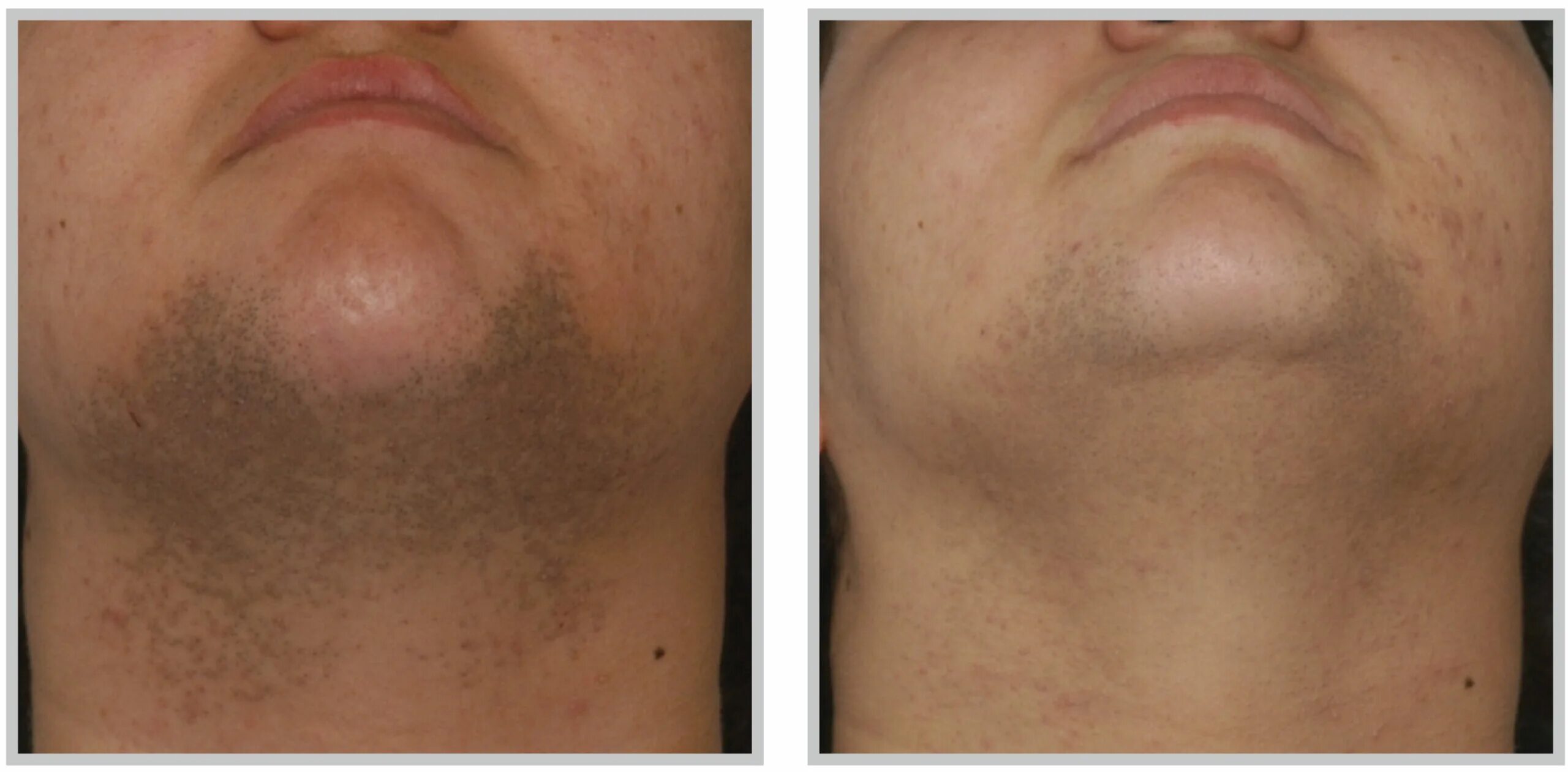 Лазерная эпиляция лица для мужчин. Лазерная эпиляция лица до и после. Мужская лазерная эпиляция до после. Через сколько после бритья