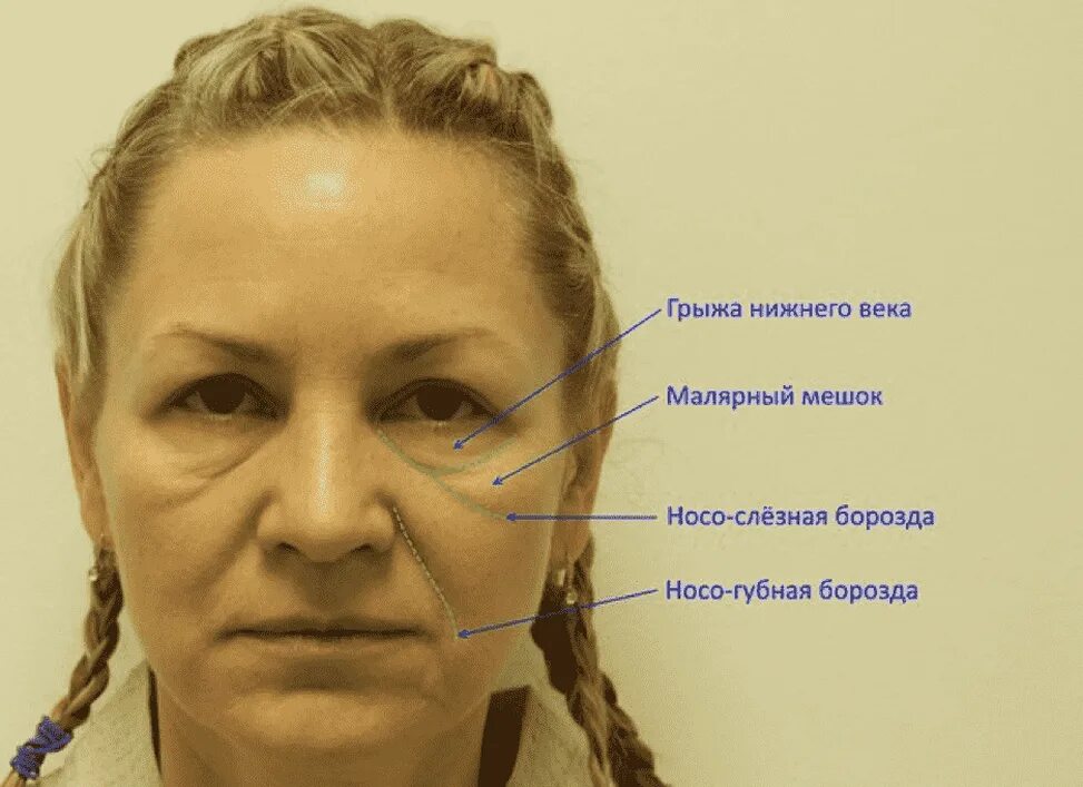 Народные от отеков на лице