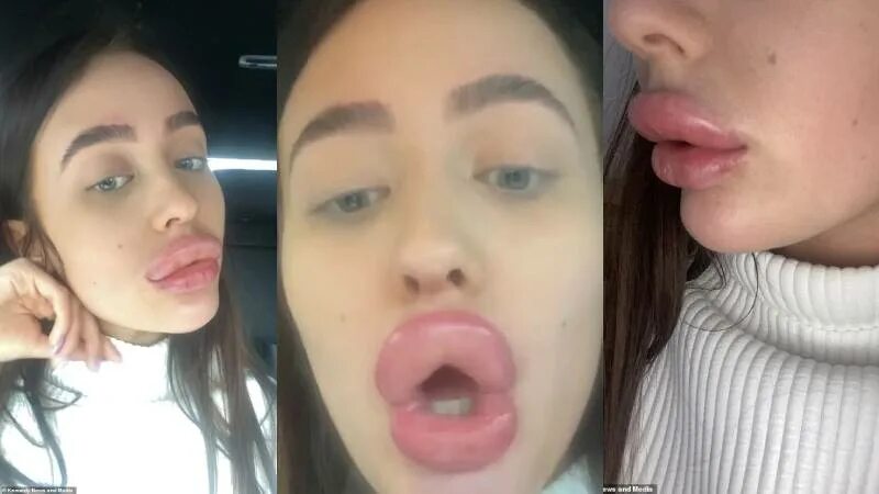 фрося накачала губы. девушки с надутыми губами. фрося накачала губы. фрося накачала губы. накаченные губы до и после.