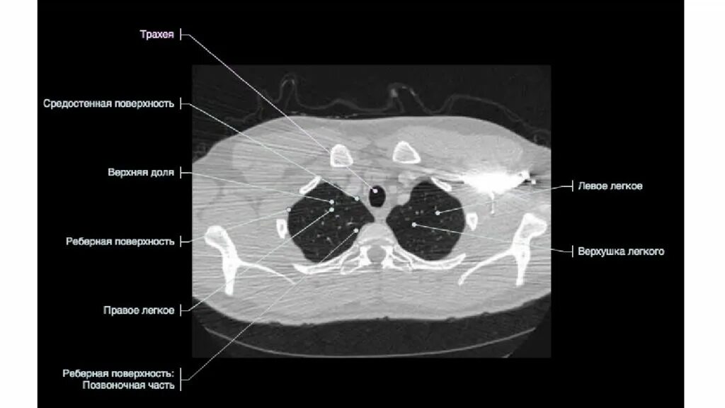 Кт анатомия грудной клетки в норме. Кт органов грудной клетки с обозначениями. Аксиальная кт грудной клетки анатомия. Кт грамма нормальной грудной клетки.