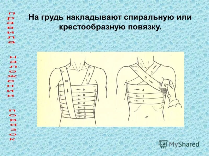 Повязка на грудную клетку алгоритм. Наложите повязку на молочную железу. Типы повязок на грудь. Крестообразная повязка на грудь. Правила наложения повязок.