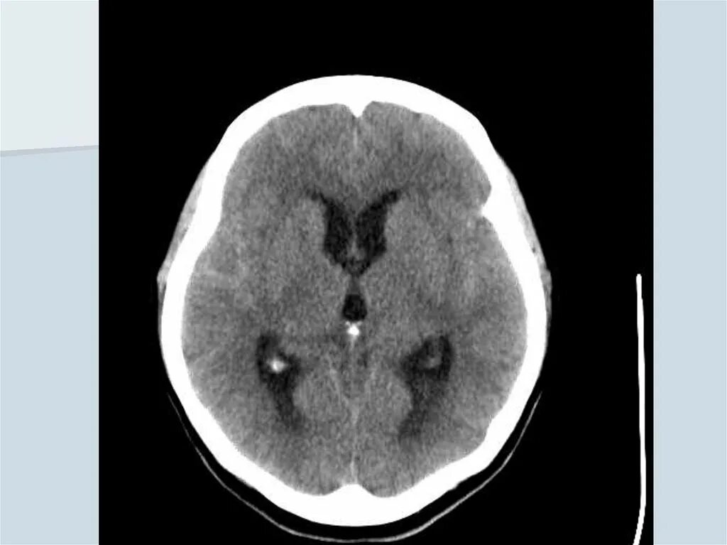 Коллоидная киста головного мозга на кт. Субарахноидальное кровоизлияние кт. Аневризма с кровоизлиянием кт. Субарахноидальное кровоизлияние на кт межполушарной. Кровоизлияние в желудочки