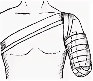 Возвращающаяся повязка на культю плеча. Десмургия повязка возвращающаяся. Возвращающаяся повязка на культю бедра. Наложение повязки на культю конечности.