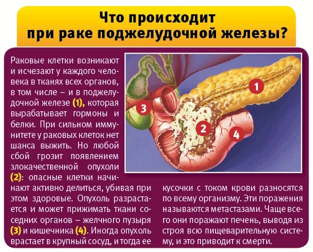 Воспаление печени поджелудочной железы. Онко поджелудочной железы. Опухоль поджелудочной. Стадии онкологии поджелудочной железы. Раковая опухоль поджелудочной железы.