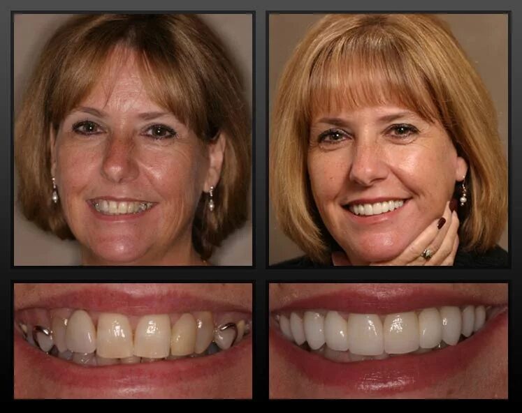 Через сколько можно вставлять зубы. Несъемные зубные протезы. Импланты зубов до и после. Съемные протезы передних зубов. Импланты передних зубов.