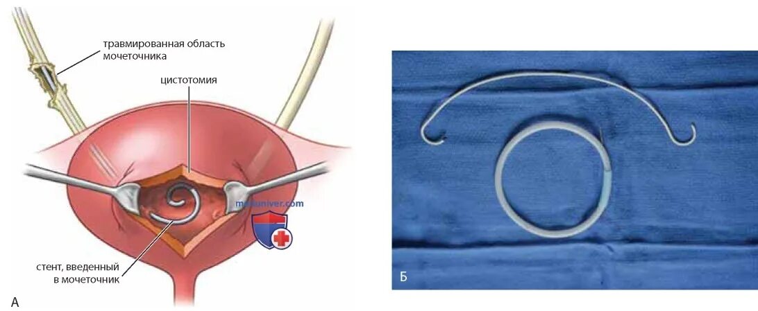 Катетеризация мочеточника. Мочеточниковые стентирование. Стентирование ВМП мочеточника. Катетер стент мочеточниковый.