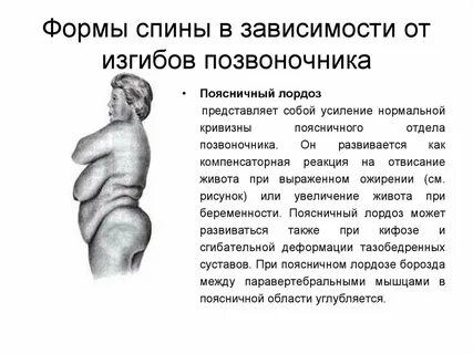 Поясничный лордоз лечение
