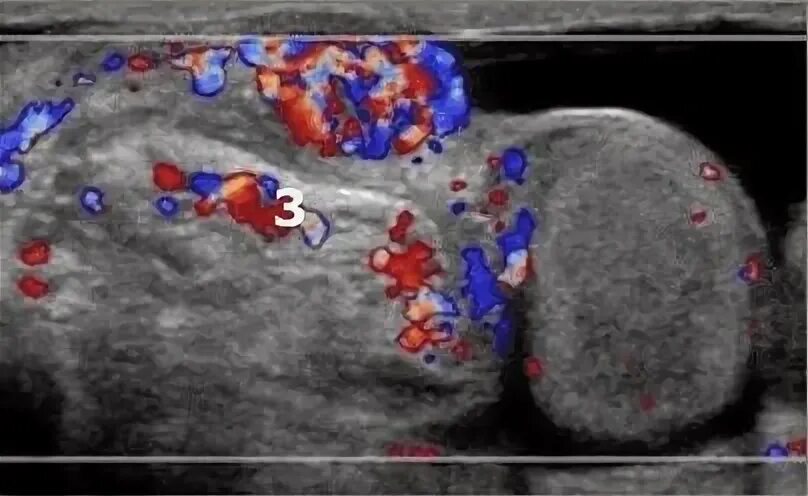 Воспаление семенного мужчин. Воспаление семенного канатика на УЗИ. Фуникулит семенного канатика. Фуникулит УЗИ семенного канатика. Фуникулит – воспаление семенного канатика.